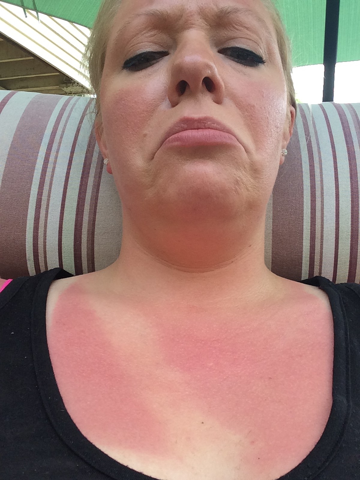 Worst Sunburn Fails Ever [PHOTOS]