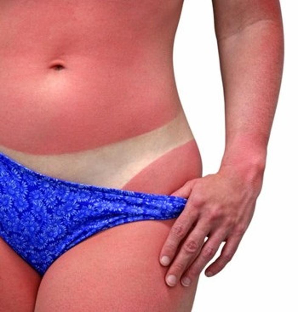 Home Remedy for Sunburn