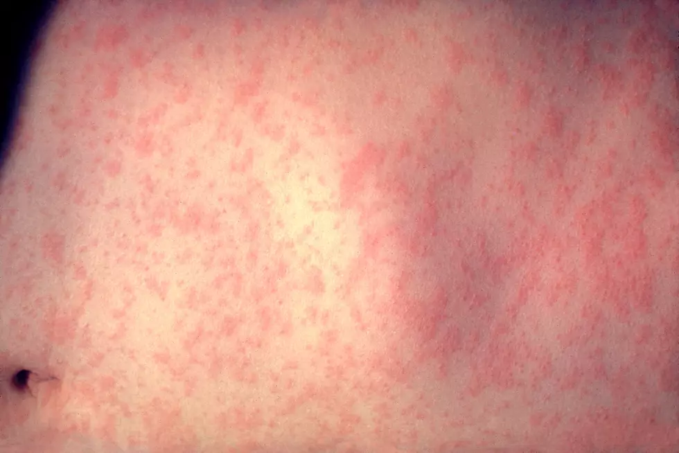 Possible Measles Exposure