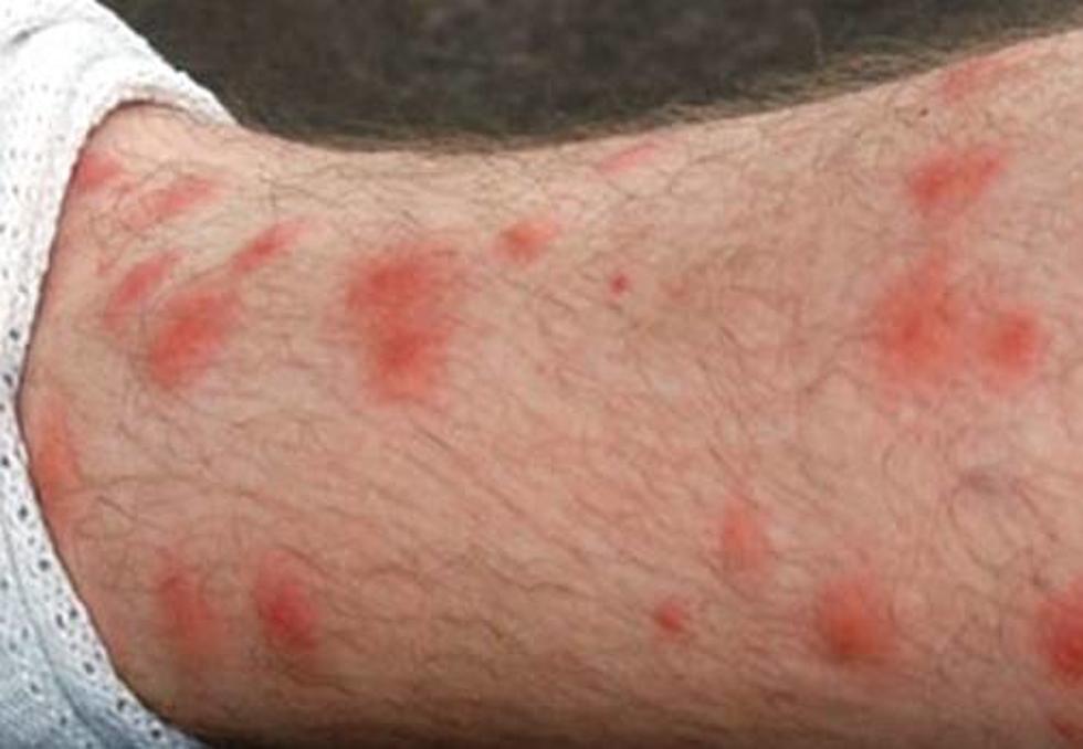 How To Get Rid Of Chigger Bites [Video]