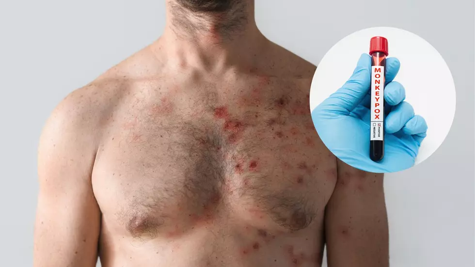 Albany Confirms First Case of Rare Monekypox Virus &#8211; Now What?