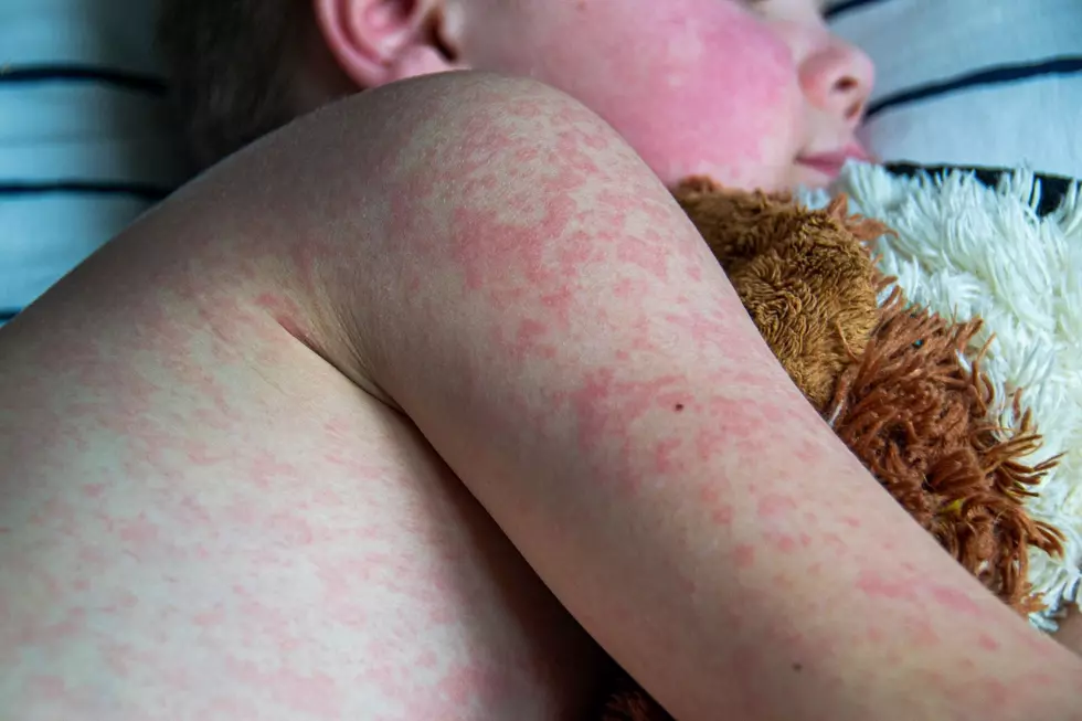 A young boy with measles rashes