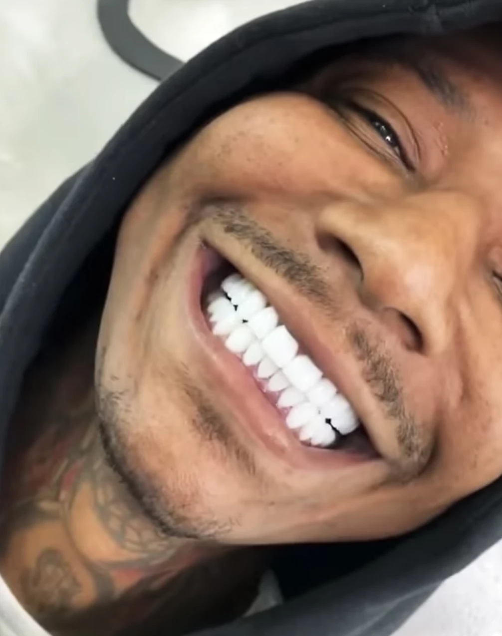 Rappers Ditched Their Grills for Really Expensive New Teeth - XXL