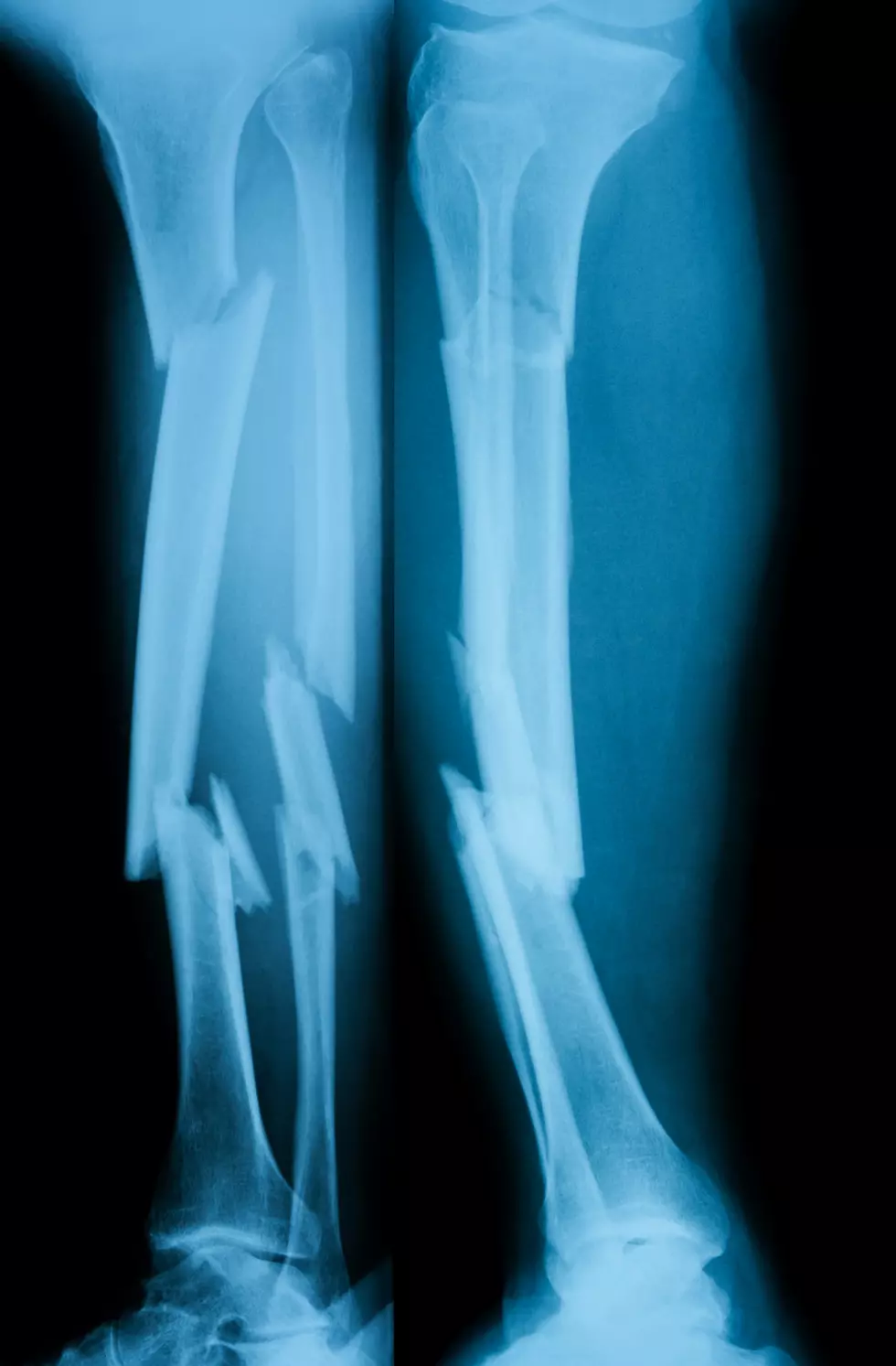 X-ray image of broken leg, AP view and lateral view. Showing tibia and fibula fractures.