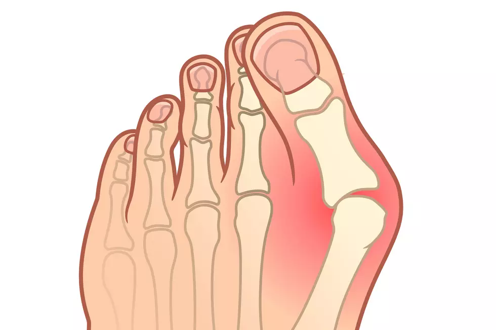 Medical vector illustration of Hallux valgus types. Healthy foot, initial stage and pronounced deformation.