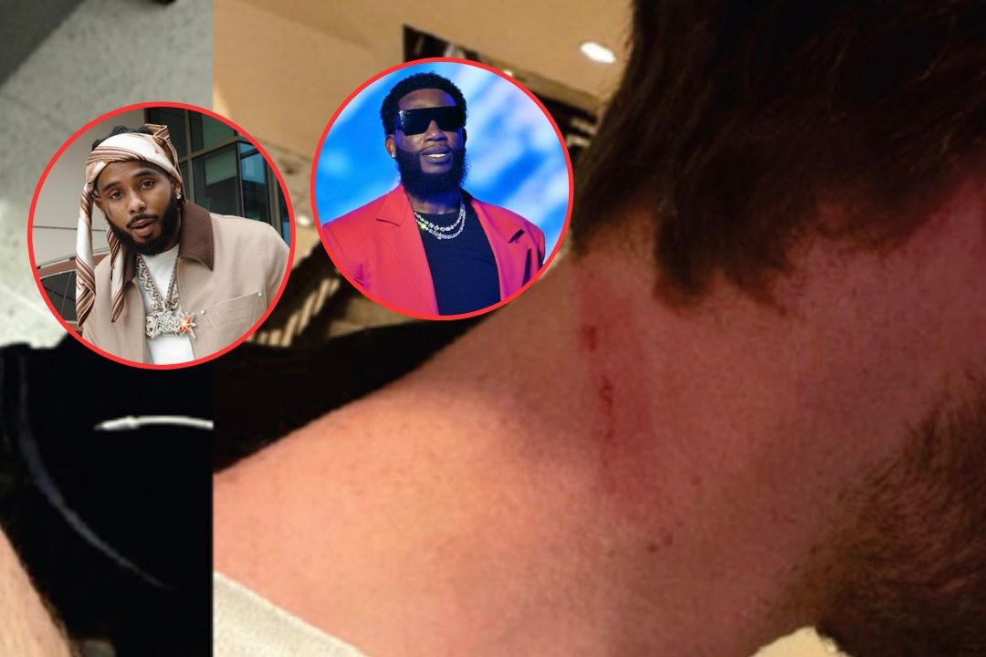Photos Show Victim's Injuries in Alleged Gucci Mane Robbery