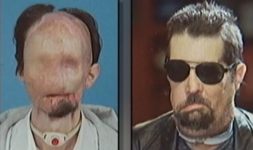 Man Who Received The Nation&#8217;s First Full Face Transplant Speaks