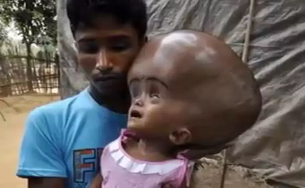 Girl With Swollen Head, Offered Help Thanks To Media [VIDEO]