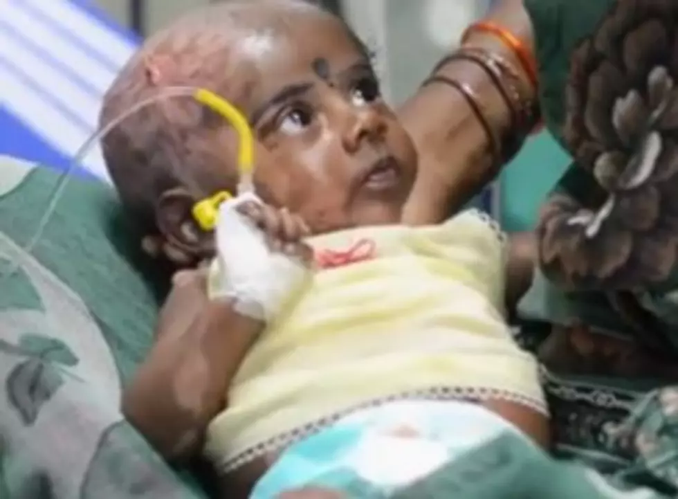 Doctors Investigate Indian Baby For Spontaneous Combustion [VIDEO]