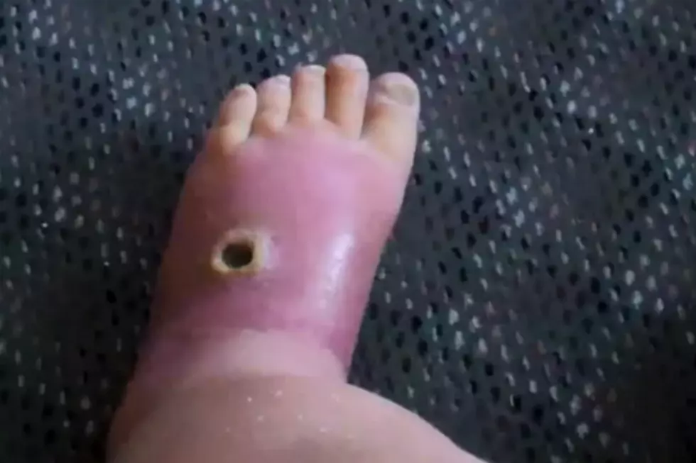 Man’s Foot is Disgusting 3 Months After Being Bit By a Spider [VIDEO]