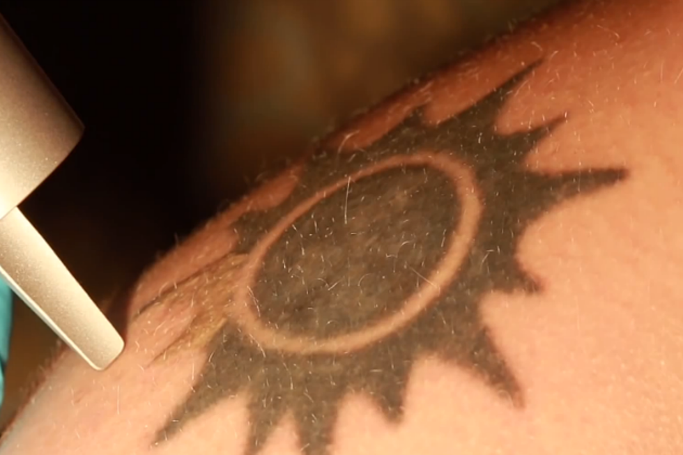 How Laser Tattoo Removal Really Works [VIDEO]