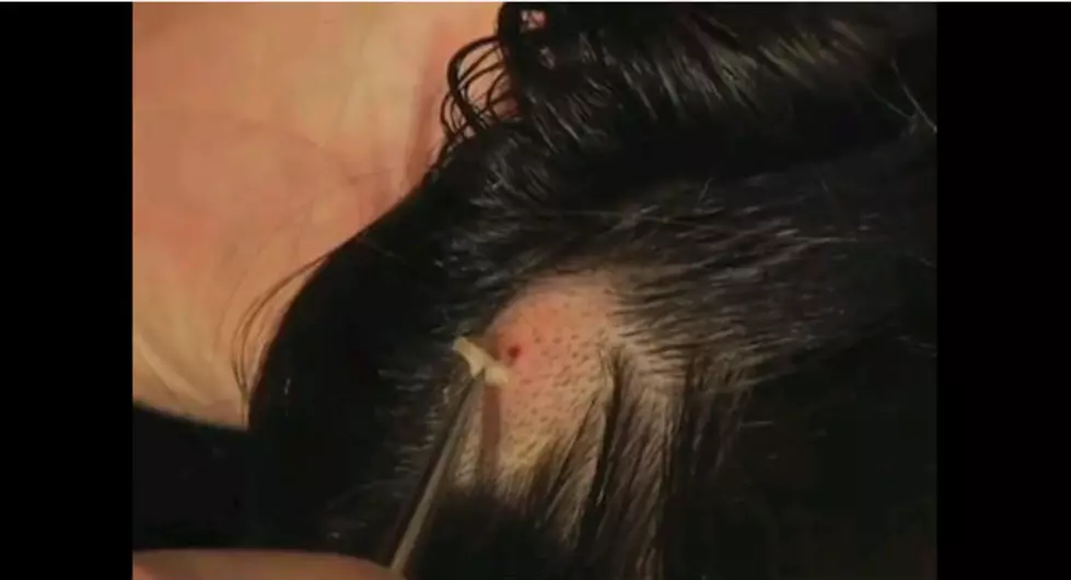 Woman Pulls Botfly Out of Her Head [Video]