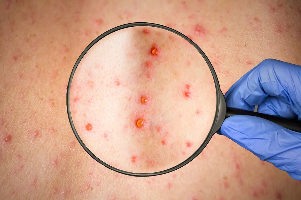 Hudson Valley Grocery Shoppers Warned of Measles Exposure