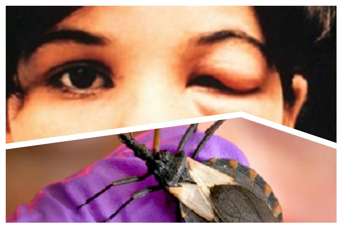 Deadly Face-Biting Kissing Bug Closing In On New York State