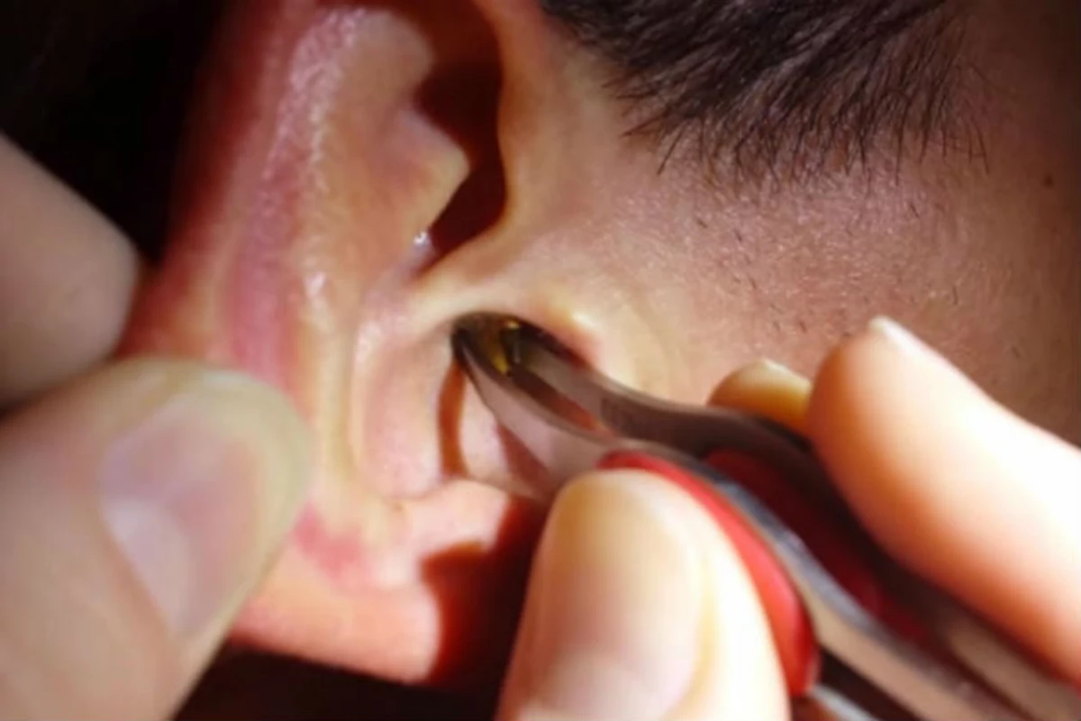 Removing a Giant Hunk of Earwax is Delightfully Disgusting [VIDEO]