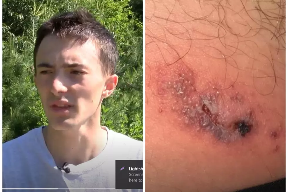 Michigan Teen Suffers From Recluse Spider Bite [VIDEO]