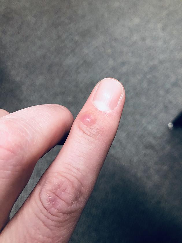 It's Not A Blister, So What Is This Thing On My Finger?