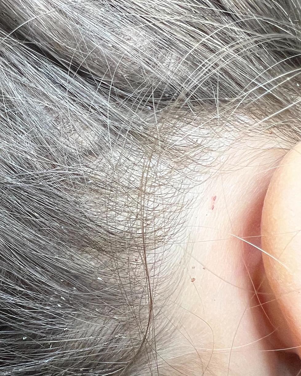 Head Lice In Massachusetts: What You Need To Know