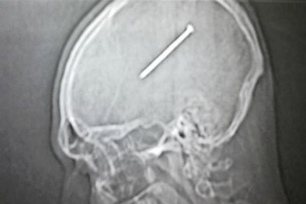 Man Doesn’t Notice He Shot a Nail Into His Skull