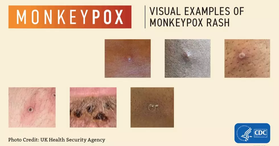 Examples of Monkeypox rash